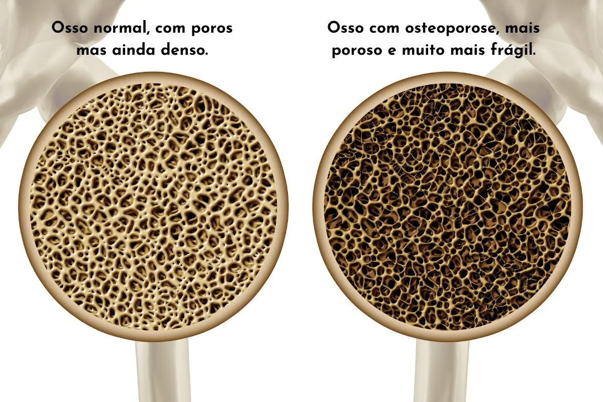 Osteoporose: Compreendendo, Prevenindo e Gerenciando a Saúde Óssea na Terceira Idade