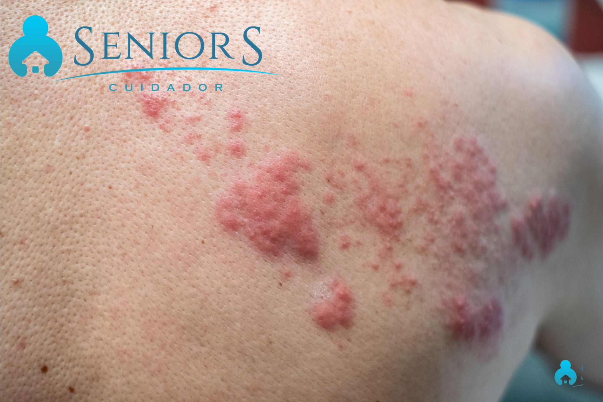 HERPES DE ZOSTER NA TERCEIRA IDADE