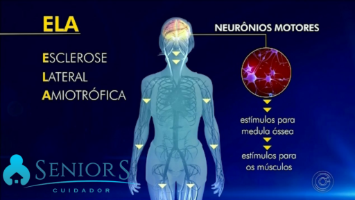 ESCLEROSE LATERAL AMIOTRÓFICA