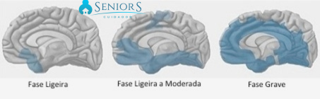 QUAIS AS FASES DA DOENÇA DE ALZHEIMER?