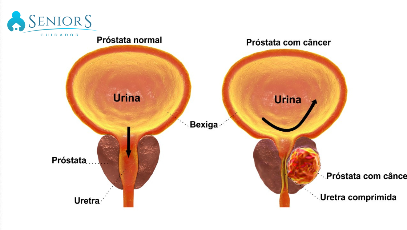 O QUE É CÂNCER DE PRÓSTATA? E QUAIS SÃO OS PRIMEIROS SINAIS?